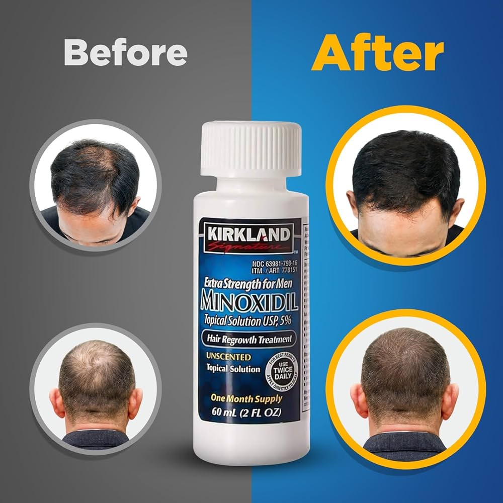 Minoxidil 5% Kirkland 1month supply original